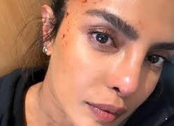 Priyanka Chopra Injured During Shooting