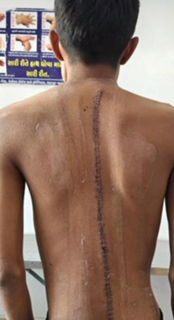 ધારપુર G.M.E.R.S હોસ્પિટલમાં આયુષ્માન યોજનાથી સ્કોલિઓસિસની સફળ સર્જરી ધારપુર G.M.E.R.S હોસ્પિટલમાં આયુષ્માન યોજનાથી સ્કોલિઓસિસની સફળ સર્જરી