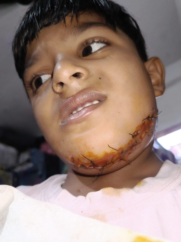 બાળક ઉપર શ્વાન નો હુમલો