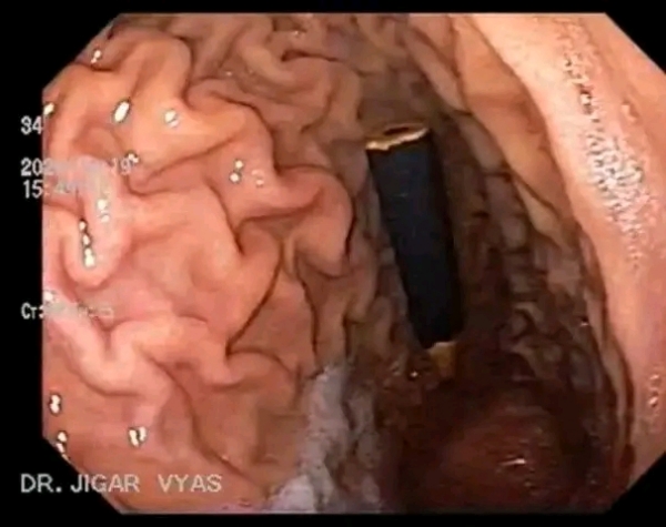 વાલીઓ માટે ચેતવણીરૂપ ઘટના : કડીમાં બાળક 5 સે.મી. પેન્સિલ ગળી ગયું, એન્ડોસ્કોપીથી સલામત બહાર કાઢાયું