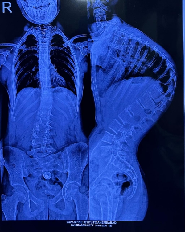 વાંકી વળેલી કરોડરજ્જુને મળી સ્મિતની સીધી રેખા ઈન્ડો-અમેરિકન ડૉક્ટરોએ બાળકોના જીવનમાં રેલાવી નવી આશા