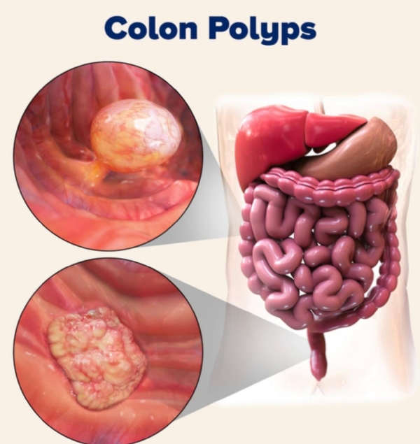 ઓપન સર્જરીને અલવિદા !! મિનિમલી ઇનવેસિવ ટેક્નિકથી સફળ પોલીપેક્ટોમી ઓપન સર્જરીને અલવિદા !! મિનિમલી ઇનવેસિવ ટેક્નિકથી સફળ પોલીપેક્ટોમી