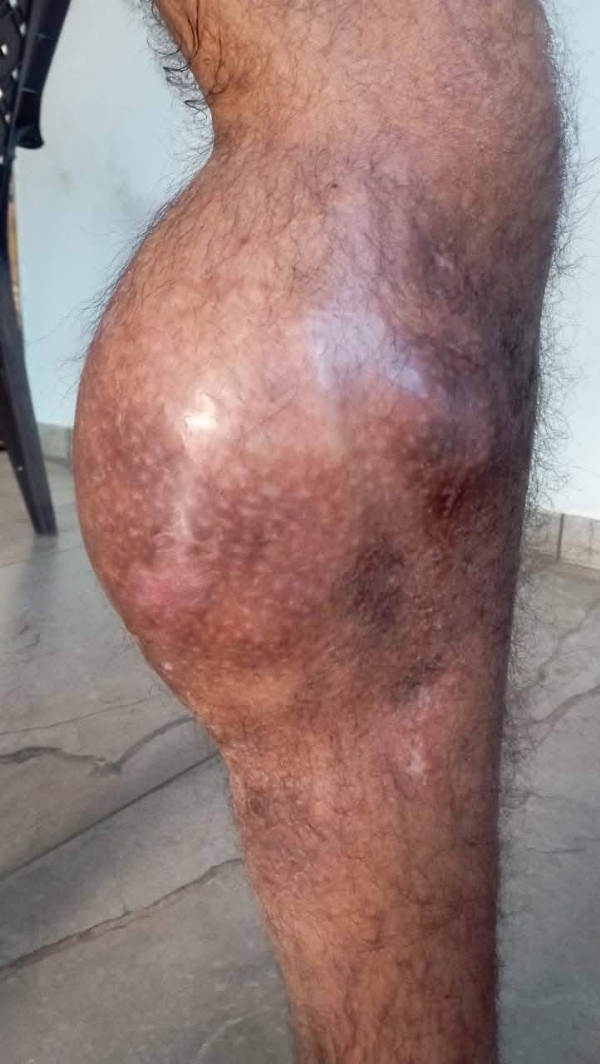 હીમોફીલીયાના દર્દી