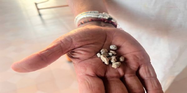 મહેસાણા સિવિલમાં 40 વર્ષના યુવકની કિડનીમાંથી 35 મિમીની પથરી કાઢી, ખાનગી હોસ્પિટલમાં ₹80-90 હજારનો ખર્ચ જણાવાયો હતો